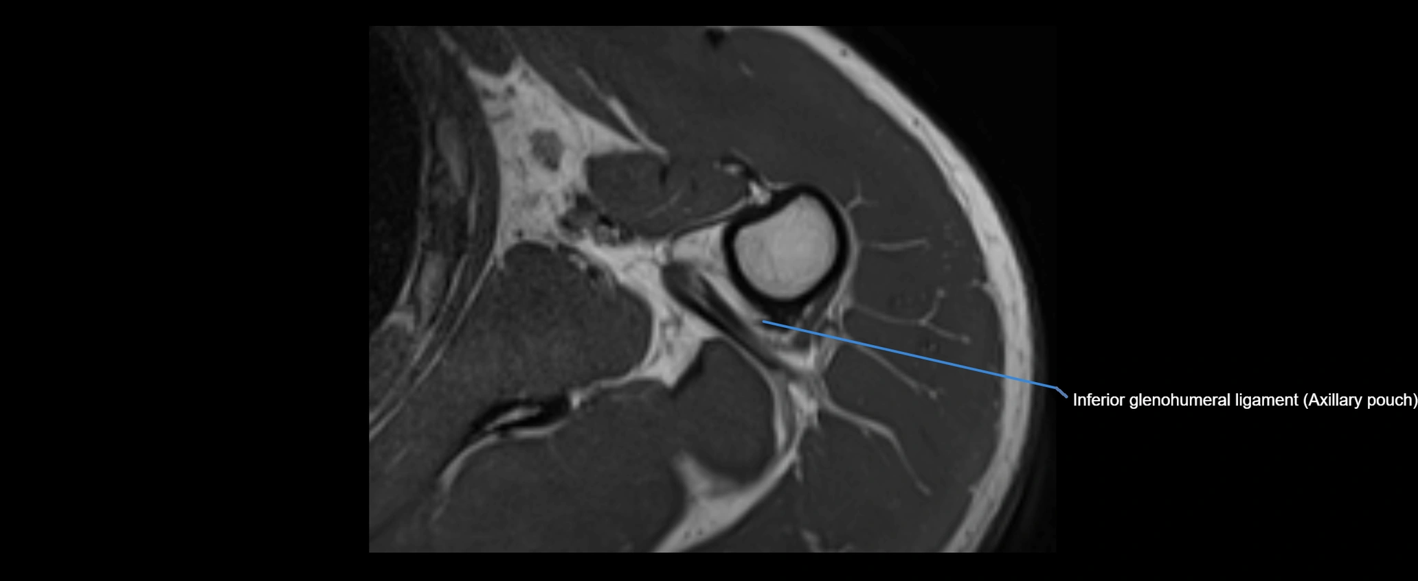 shoulder ligaments axial 3d 3t mri image-img-00005-00101.webp